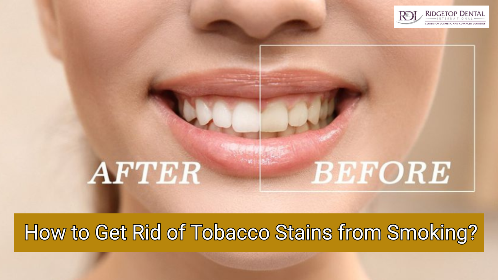 How to Get Rid of Tobacco Stains from Smoking